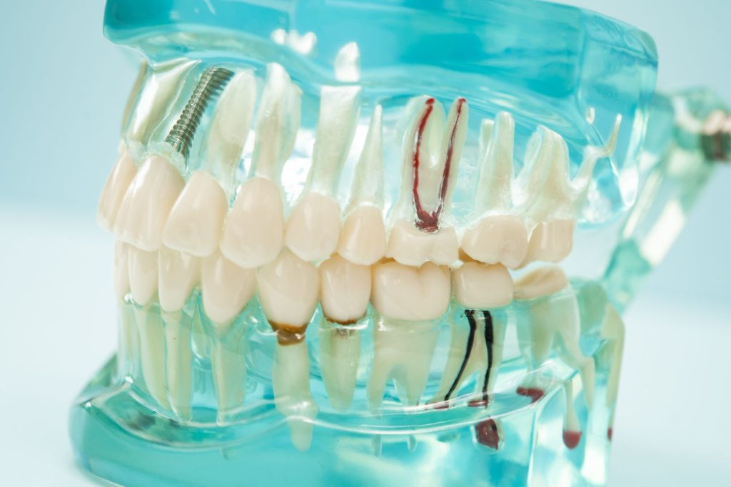 tratamiento de conducto MS Dental