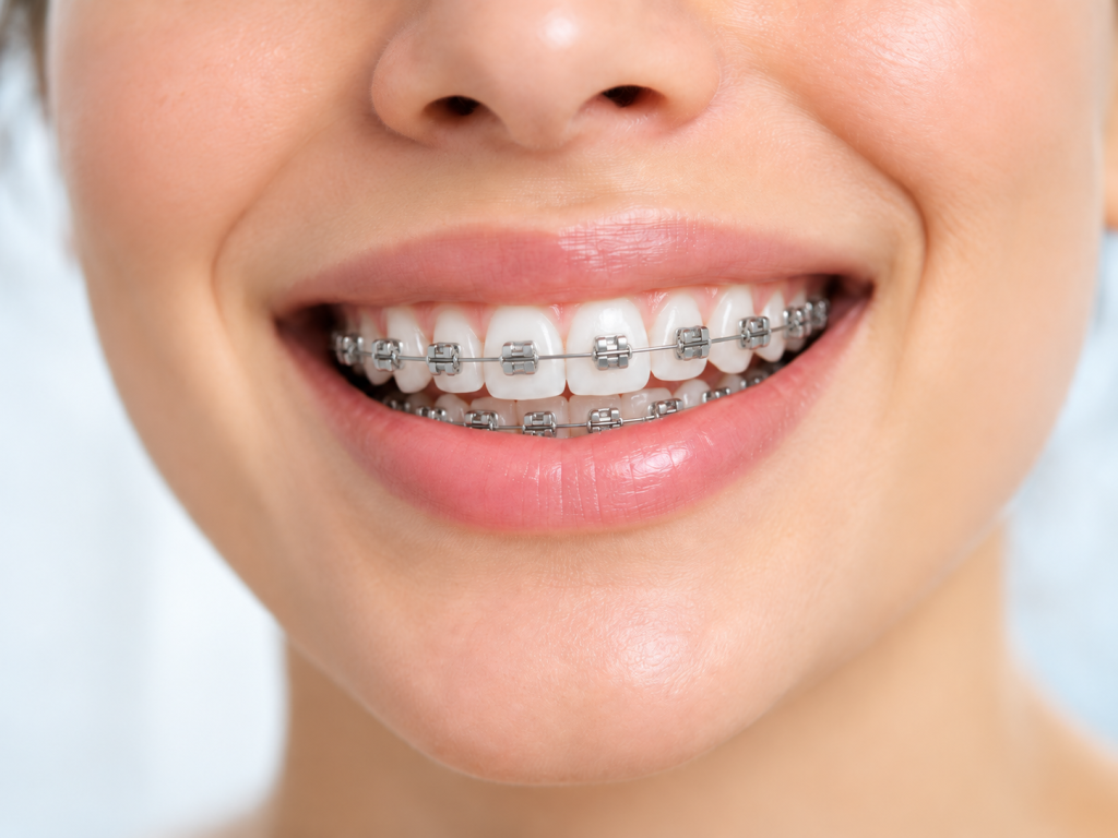 Brackets Autoligado Providencia
