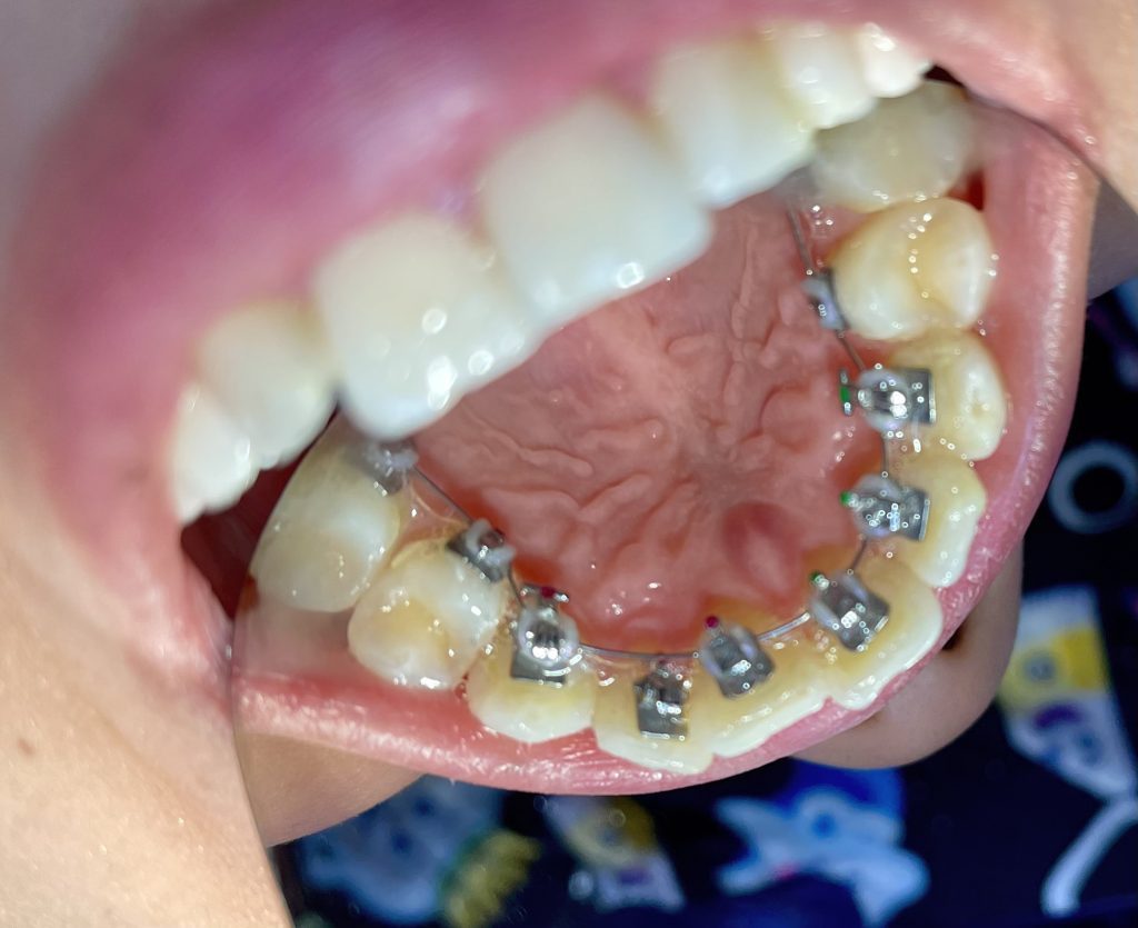 Brackets Linguales en Providencia